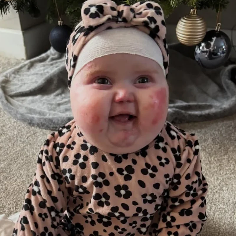 Vivi, bebê com lesões de epidermólise bolhosa no rosto